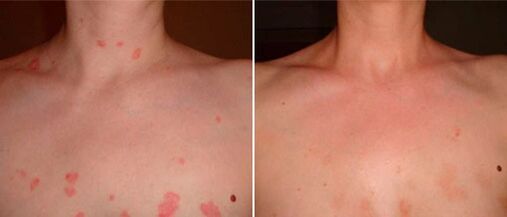 Psoriasis before and after Keramin cream treatment