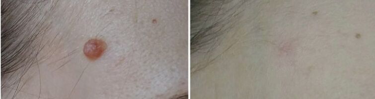 Before and after laser removal of papilloma 2