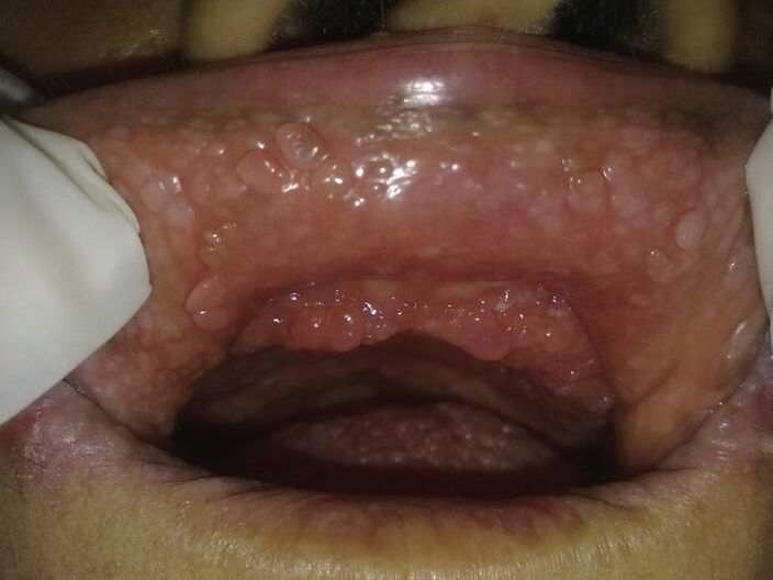papilloma in mouth