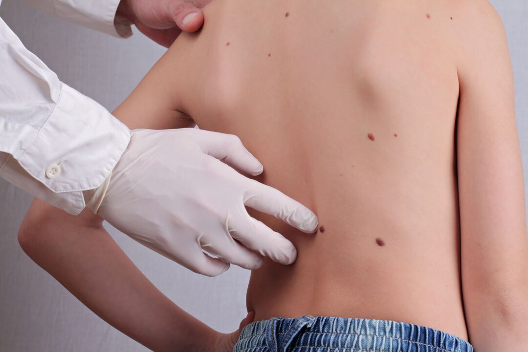 Dermatologist performs clinical examination of patient with papillomas on body