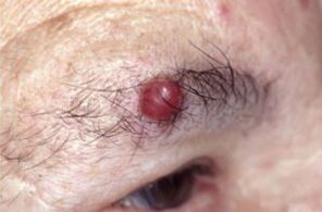 Papilloma on eyebrows