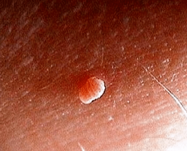 Papilloma