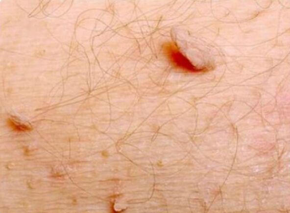 Sharp papilloma on the human body