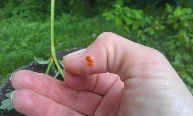 Celandine applied to fingers