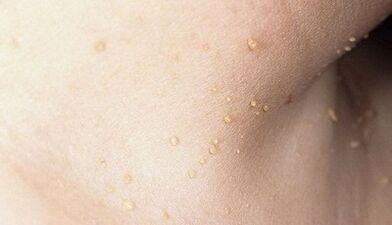 Risk of Papillomatosis in the Neck