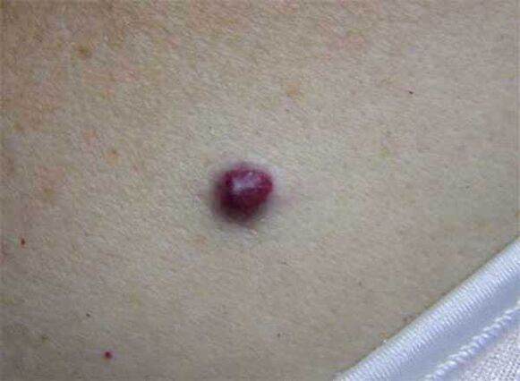 There are red moles on the body