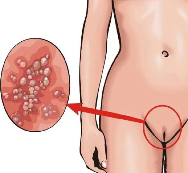 perineal papilloma