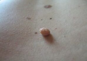 Papillomas are growths on the surface of the skin