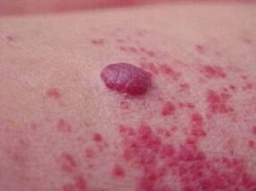 There are red spots around the papilloma