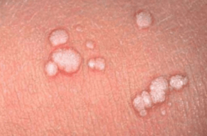 flat papilloma