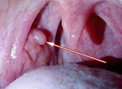 papilloma in throat