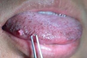 papilloma on tongue