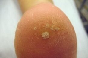 plantar warts