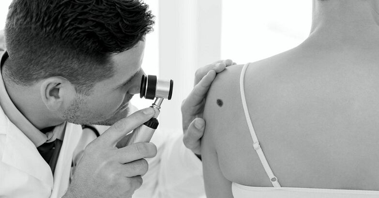 Experts diagnose types of warts