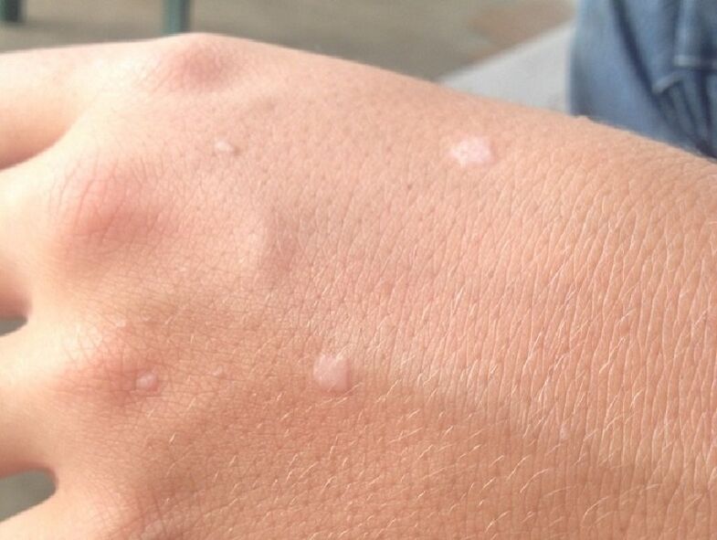 Flat warts on human skin