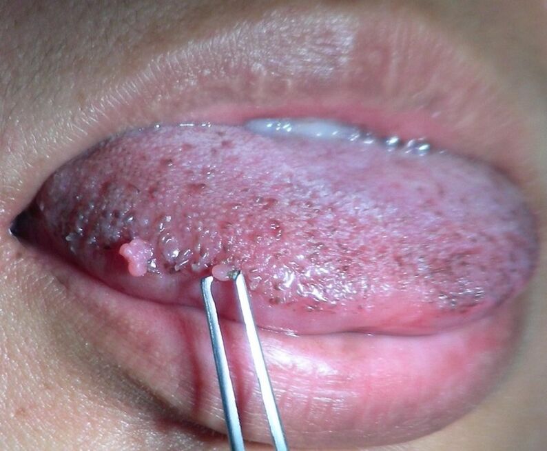 Genital warts on tongue
