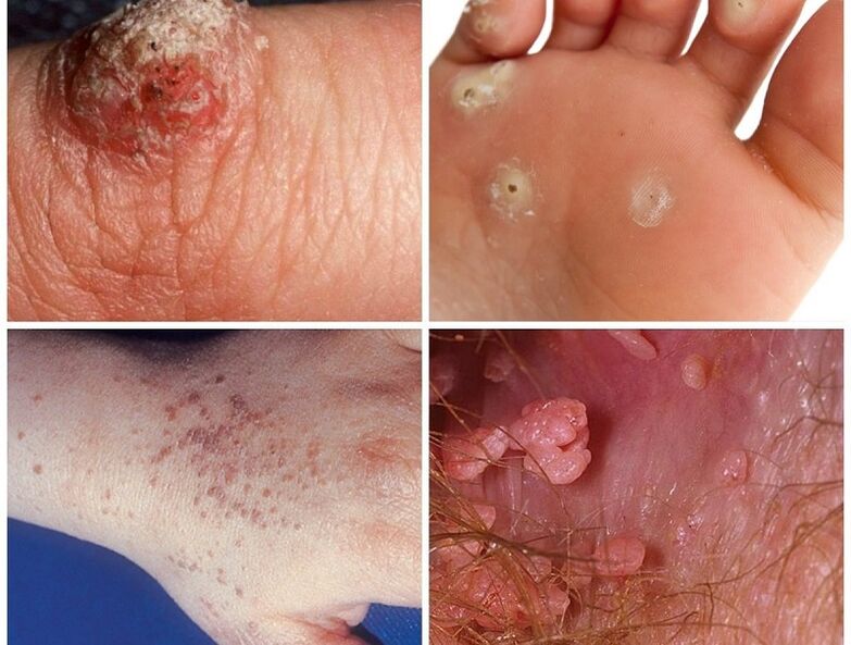 Types of human warts
