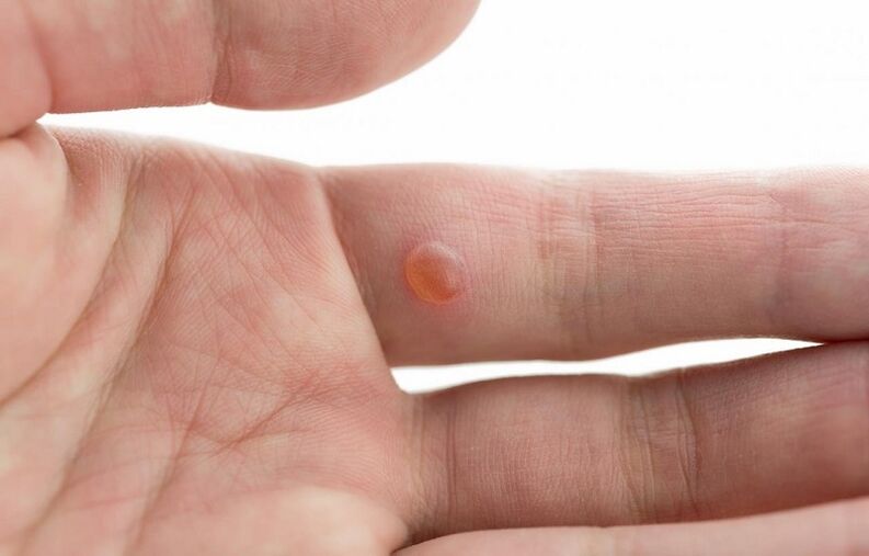 common warts on fingers