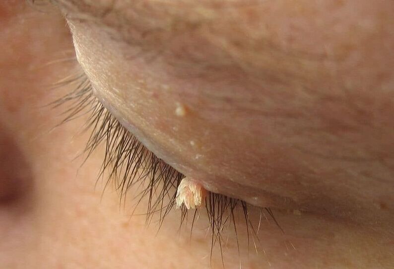 filamentous warts on eyelids