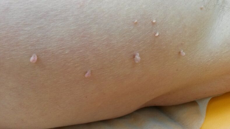 human papilloma