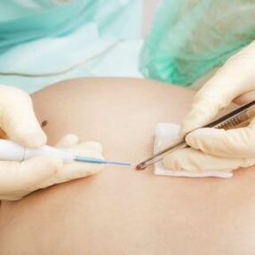 Papilloma removal by a surgeon