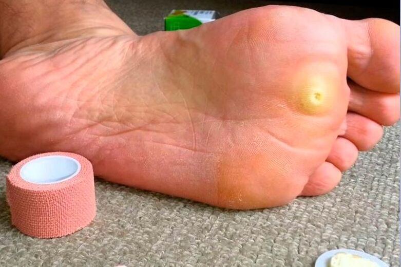 plantar warts on feet