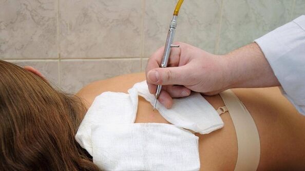 Dorsal Papilloma Electrocoagulation