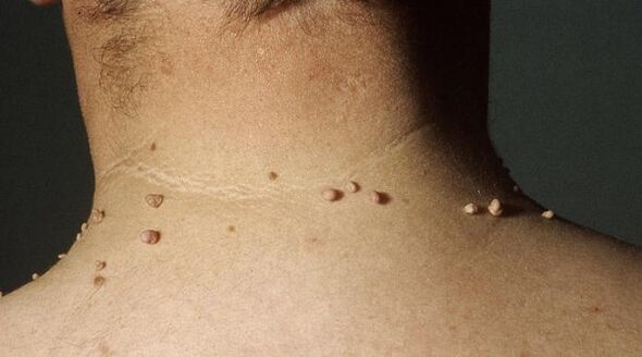 filiform papilloma of neck