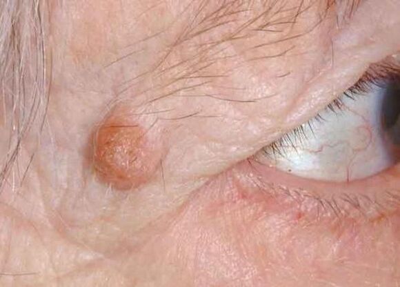 papillomas on eyelids