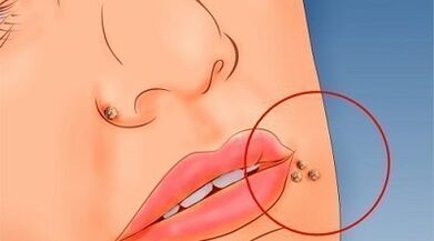 Causes of warts