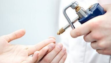 Cryodstruction as a treatment for warts