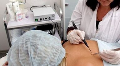 Electrocoagulation as a way to remove warts